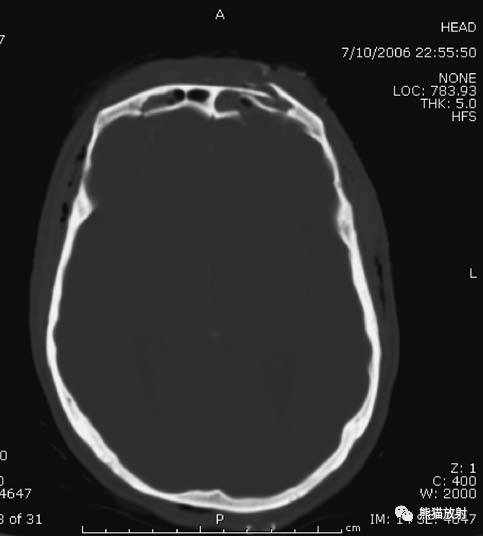 颅骨骨折健康教育ppt